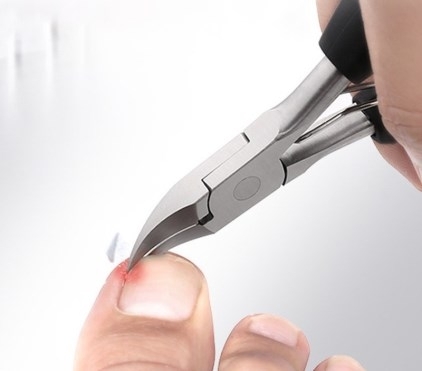 Ints búcsút a fájdalmas, benőtt, megvastagodott körmöknek! (x)