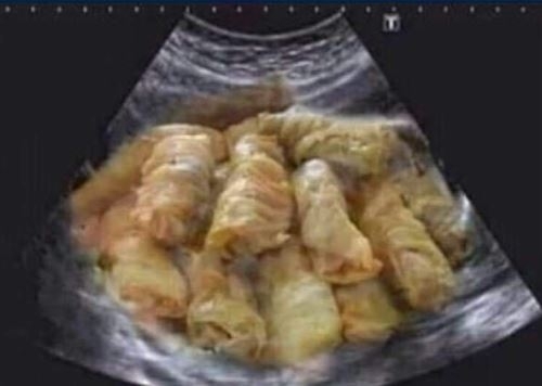 Karácsonyi ultrahang kép